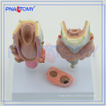 Modelo de enfermedad tiroidea PNT-0757, modelo de tiroides, modelo de anatomía tiroidea